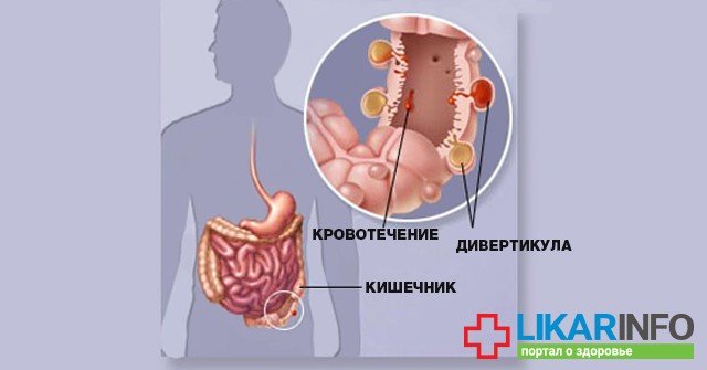 Миф 6. Дивертикулез 