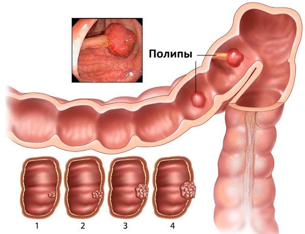 полип