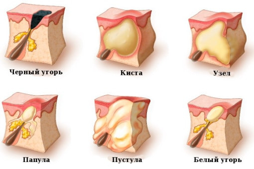  Какими бывают прыщи
