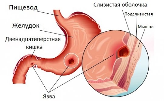  причины развития язвы желудка