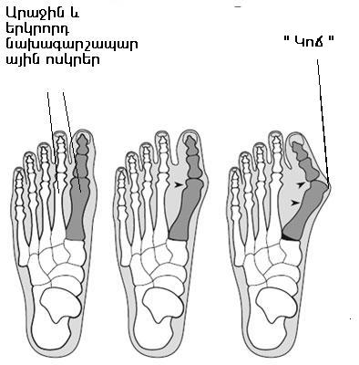 Ոտնաթաթի առաջին մատի «կոճ». հալլուքս վալգուս (hallux valgus կամ bunion)