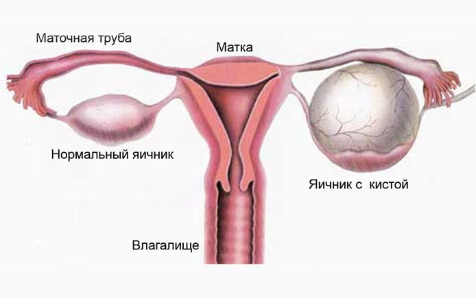 Увеличенные яичники: симптомы, причины и лечение