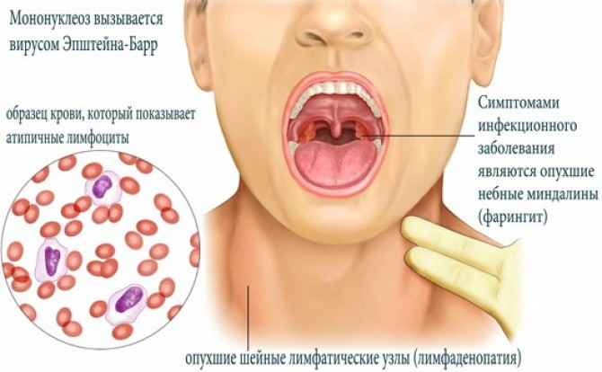  Инфекционный мононуклеоз