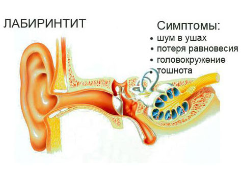 Внутренний отит или лабиринтит 