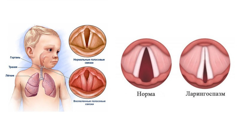 Когда малыш задыхается. Ларингоспазм: первая помощь и причины