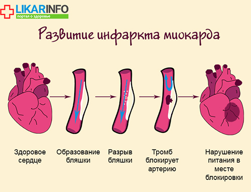 Инфаркт у женщин – атипичные